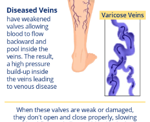 varicose