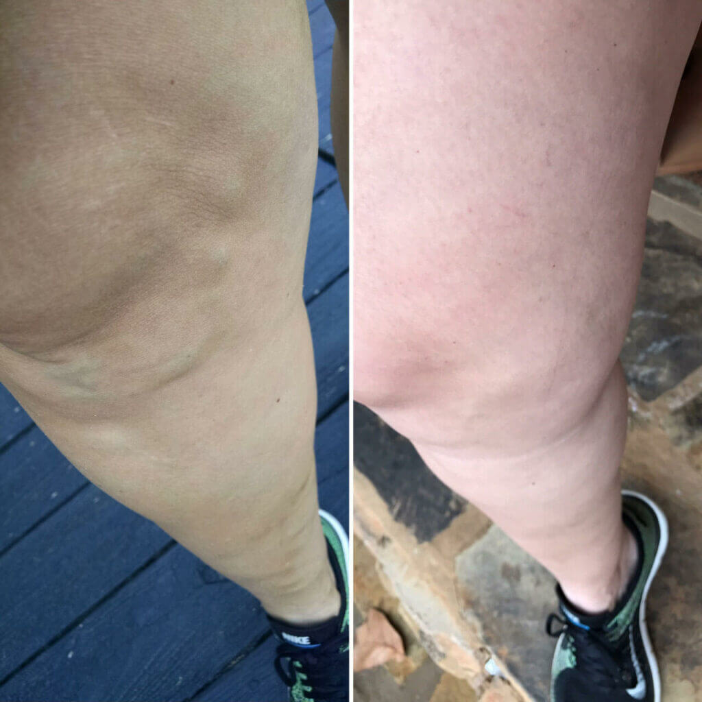 Leg Vein Treatment Before and After