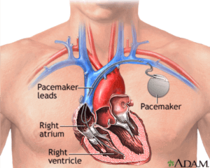 How a pacemaker works illustration