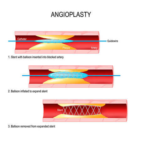 Angioplasty Diagram