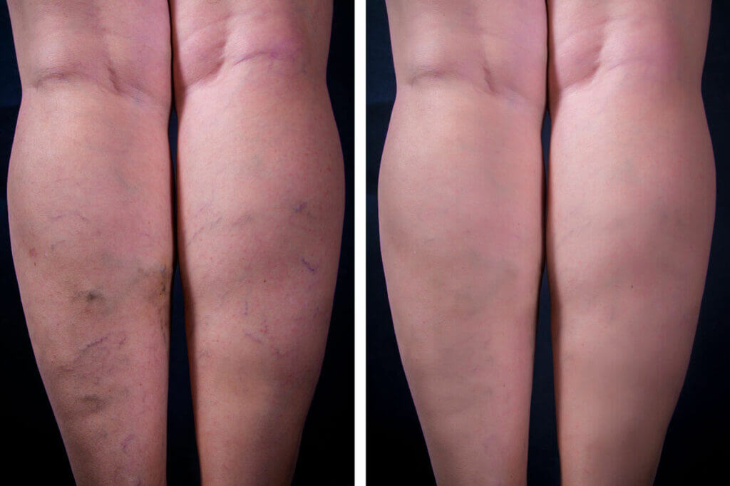 Leg Vein Treatment Before and After